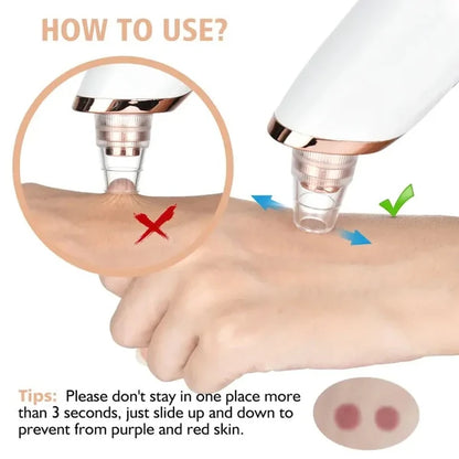 5-in-1 Blackhead Remover Vacuum – Rechargeable Facial Pore Cleaner